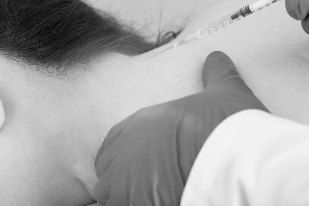 Bloqueo del nervio occipital mayor