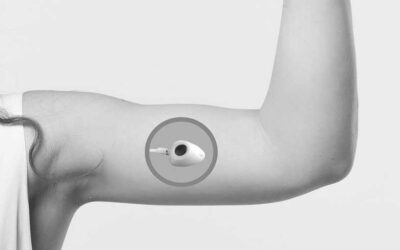 Cómo combinar la técnica y la estética en la colocación de PICC-ports