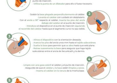 Colocación de SecurAcath