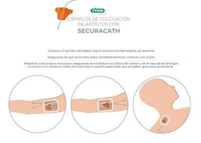Ejemplos de colocación de apósitos con SecurAcath