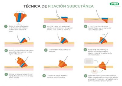 Técnica de fijación subcutánea