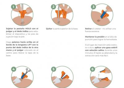 Retirada del SecurAcath con método de corte