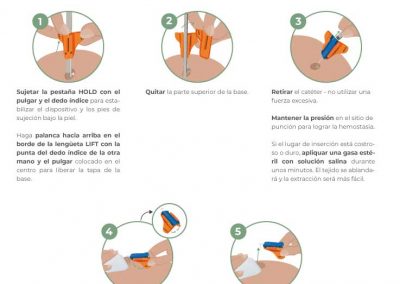 Retirada de SecurAcath con método de plegado