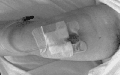 Clasificación del Midline: Mini-Midline, Midline y Midline Midclavicular