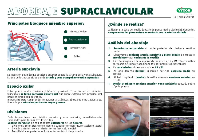 Infografía abordaje supraclavicular