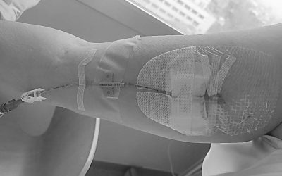 Optimizando los cuidados: análisis de malas prácticas en la gestión del catéter midline