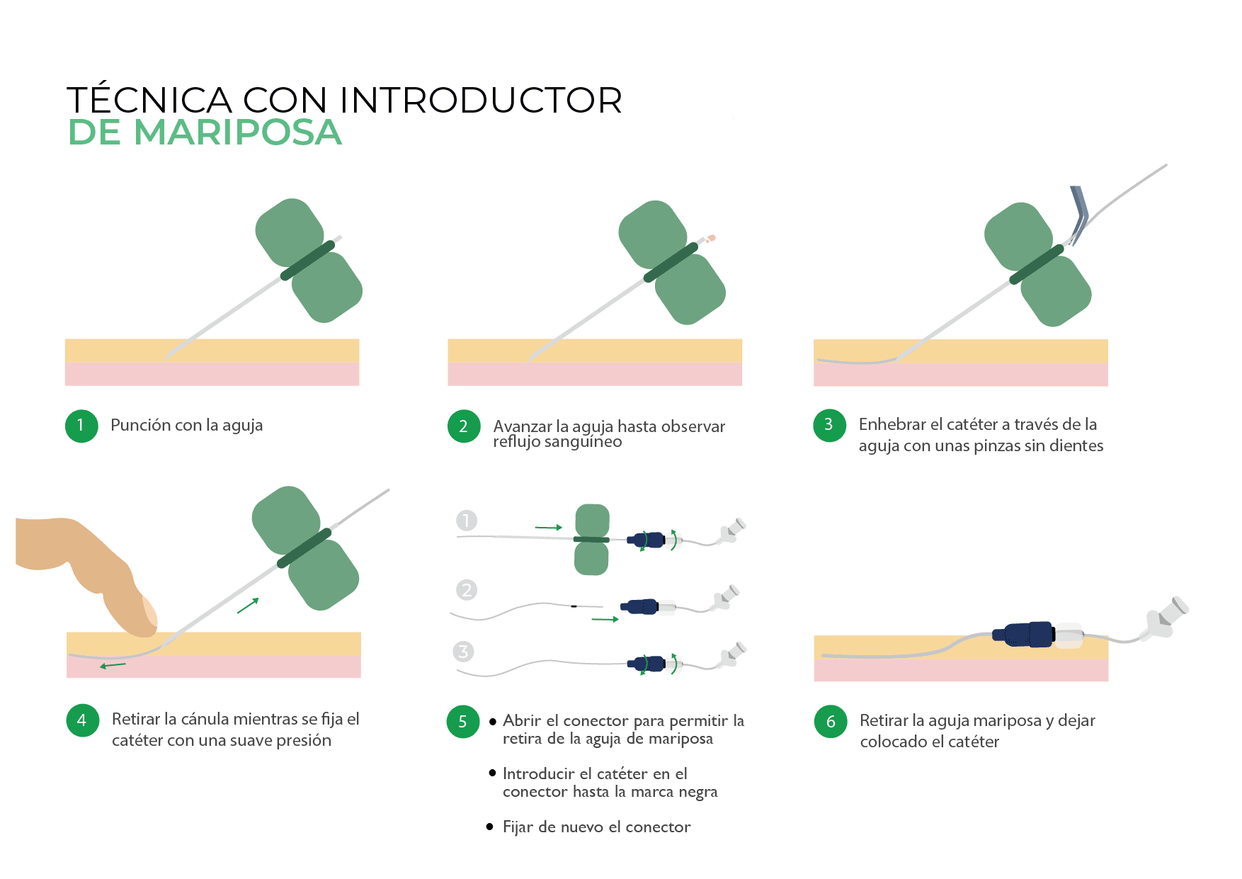 Canalización neonatal aguja mariposa