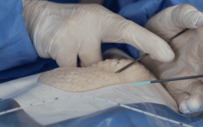 ¿Cómo reducir las extracciones accidentales y las infecciones de los DAV?: La tunelización como herramienta clave 