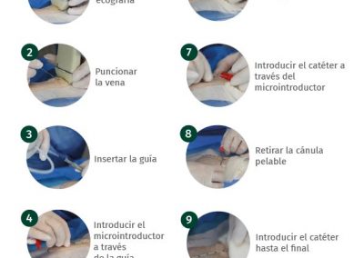 Póster técnica de inserción Microseldinger