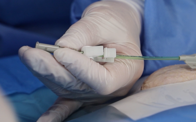 ¿POR QUÉ ES IMPORTANTE LA COLOCACIÓN CORRECTA DE LA UBICACIÓN DE LA PUNTA DEL CATÉTER? BENEFICIOS DEL SISTEMA ECG EN COMBINACIÓN CON EL CATÉTER DE CORTE PROXIMAL