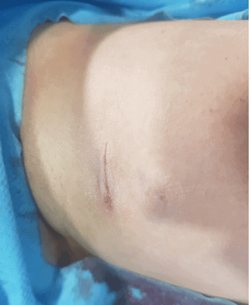 Freshly placed PICC-port with cyanoacrylate